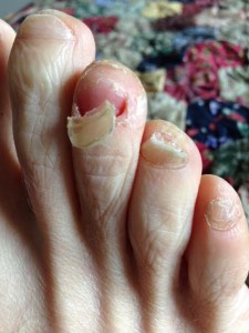 ugly runner's feet - lost another nail